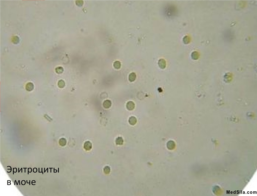Эритроциты в моче